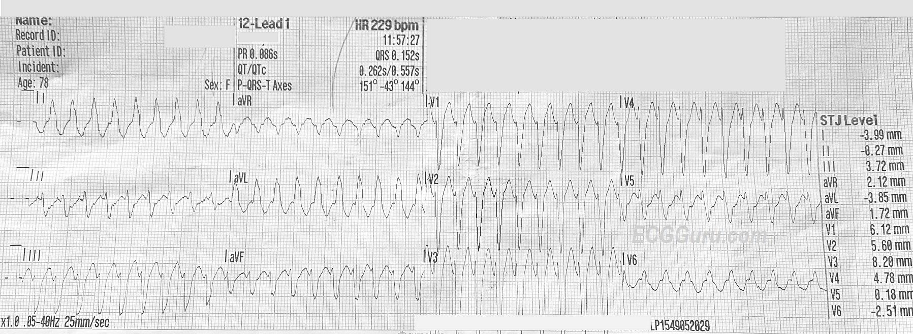 Ecg Guru Instructor Resources A Gathering Place For Instructors Of Ecg And Cardiac Topics